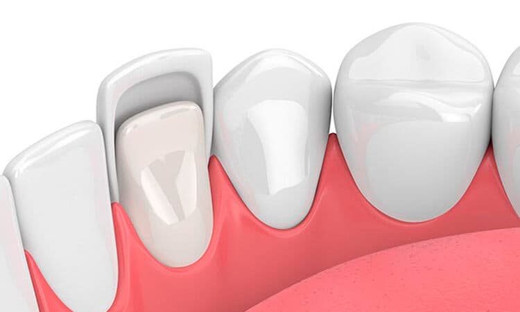 Veneers