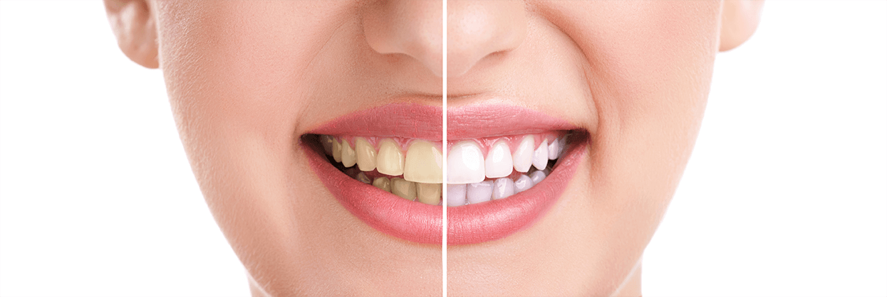 Teeth Whitening in Denville, New Jersey